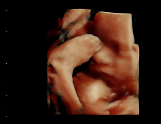 3D ultrasound image at 31 weeks